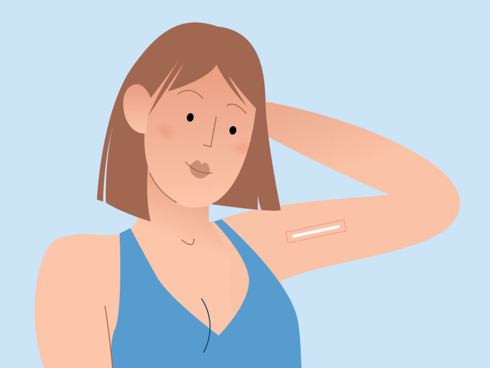 Birth control implant Effectiveness, side effects, and cost Flo